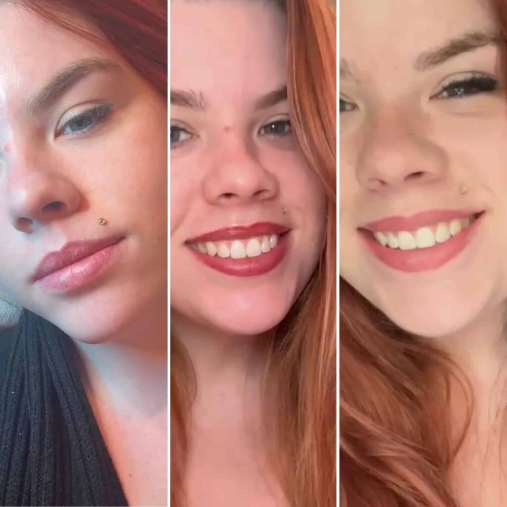 1774308049_4A559594-4D73-4ED6-89F6-1D4D06D8CB59 This Gal came in for her yearly Lip Color Boost! Pictured is before her appointment (Left), when she left that day (middle) and Fully Healed, 6 weeks later (Right)
