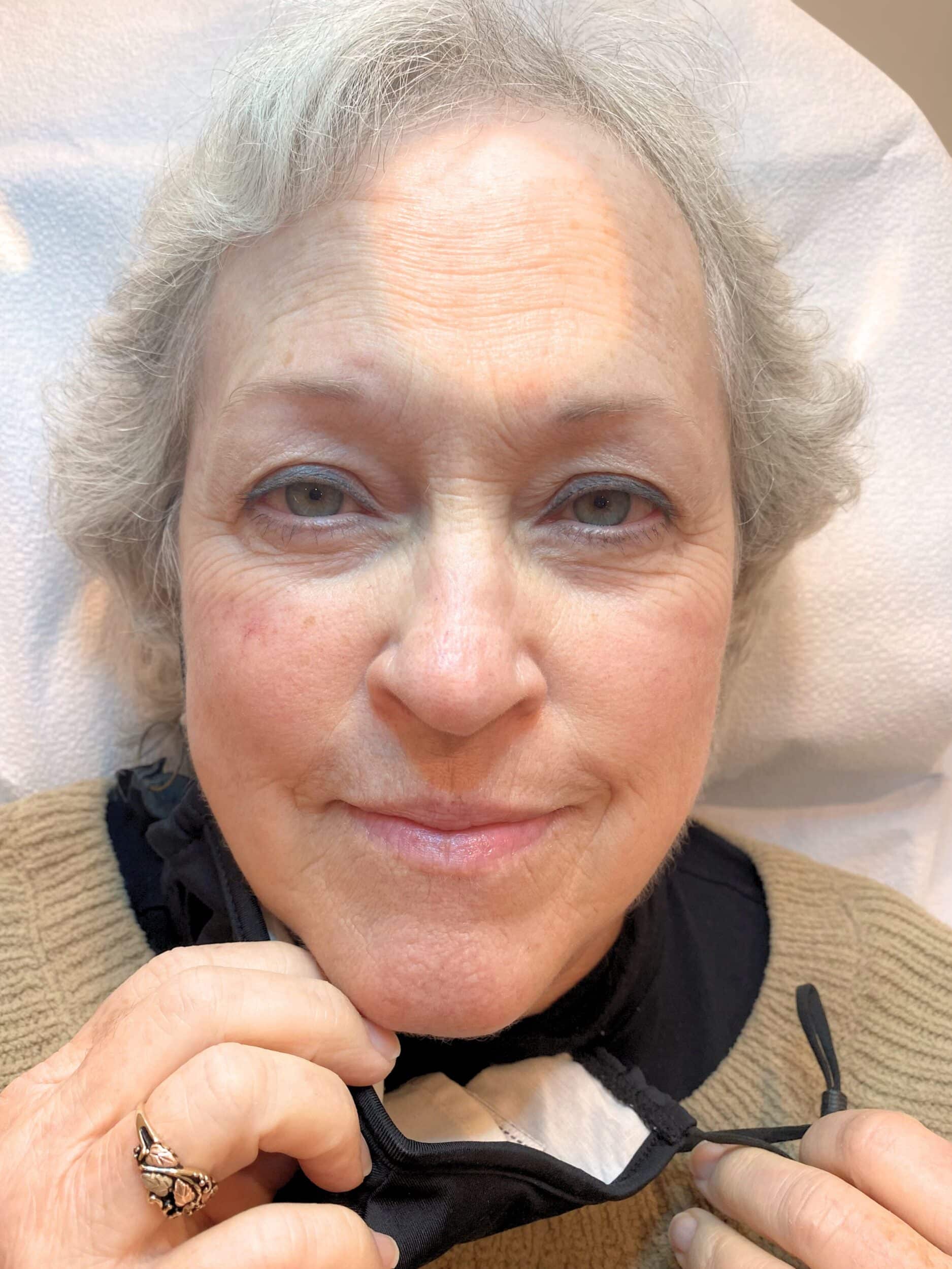 Before Image: Fully healed eyebrows after three total sessions - front