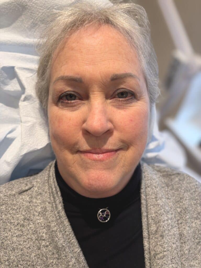 After Image: Fully healed eyebrows after three total sessions - front