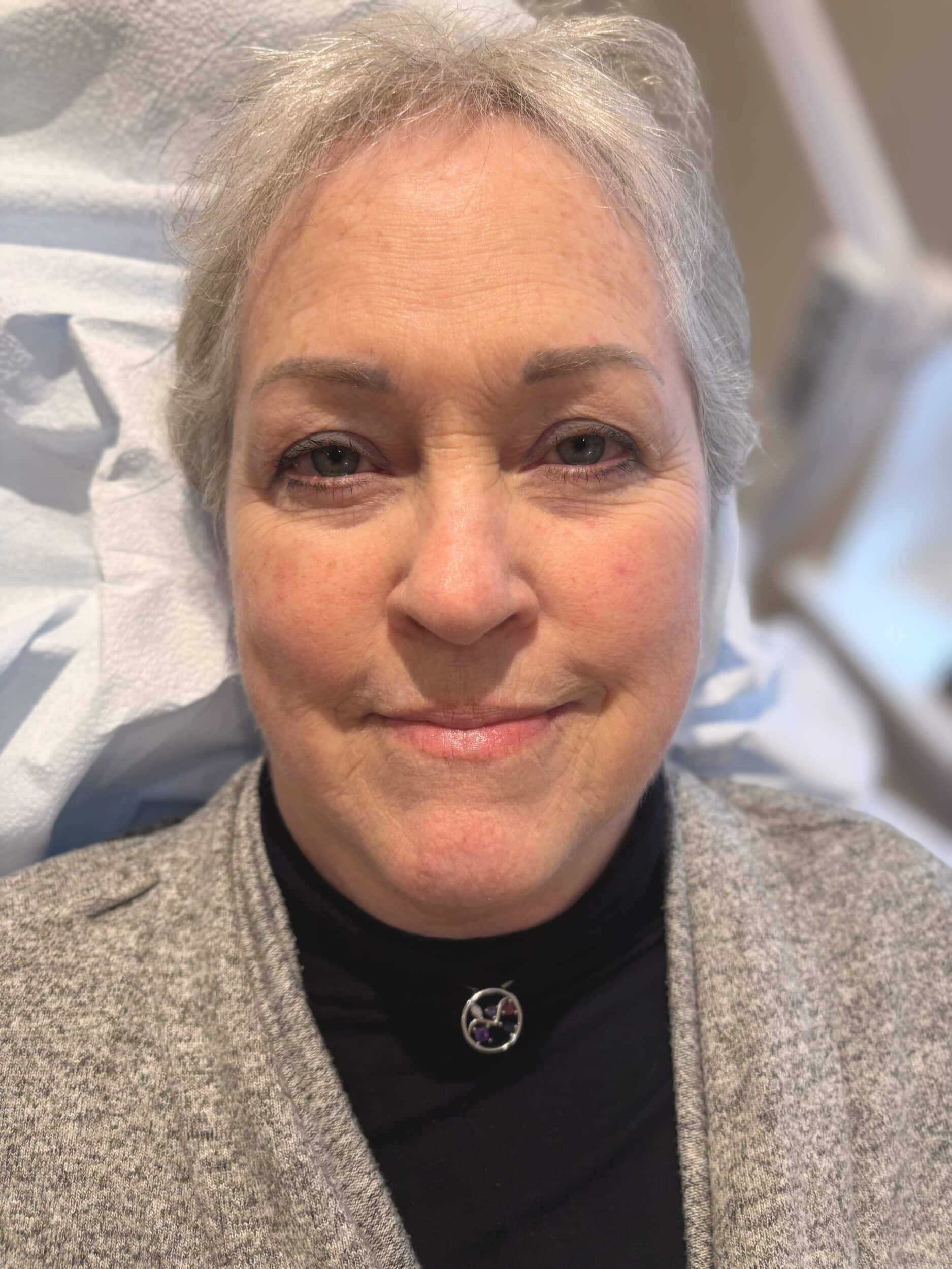 After Image: Fully healed eyebrows after three total sessions - front