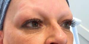 Before Image: Brows, fully healed