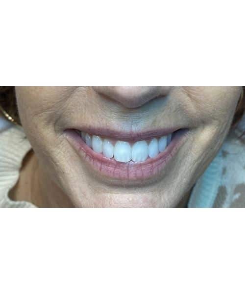 Before Image: Full Lip Color - front