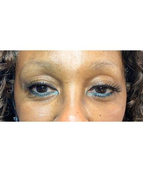 Before Image: Brows, Immediately After 2nd Session - front