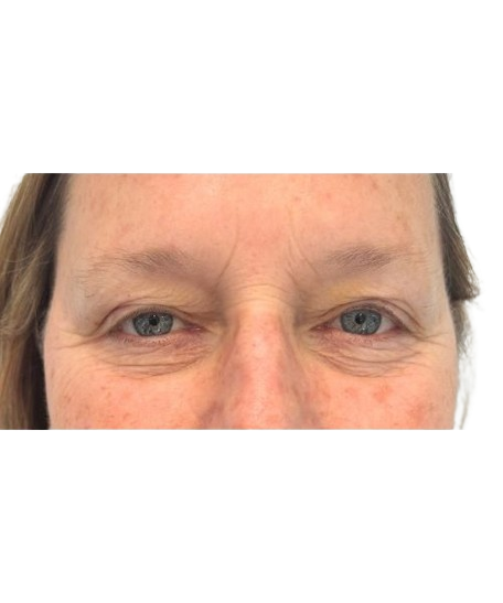 Before Image: Eyebrows - front
