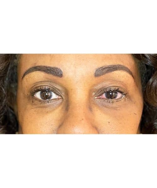 After Image: Brows, Immediately After 2nd Session - front