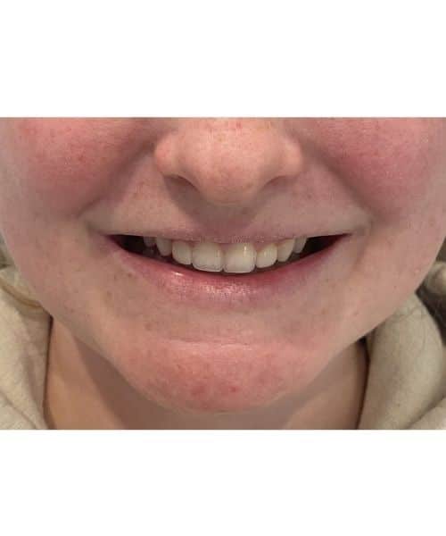 Before Image: Lips - front