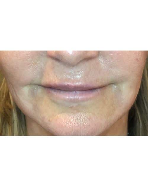 Before Image: Before and After fully healed lips - front