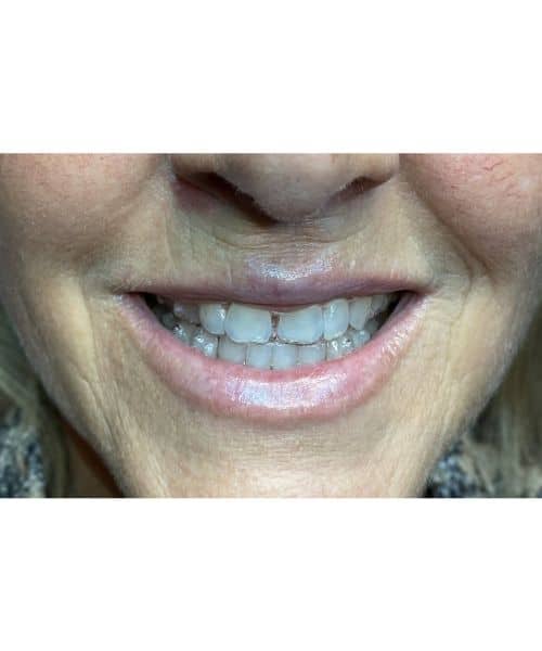 Before Image: Before and After Full Lip Color - front