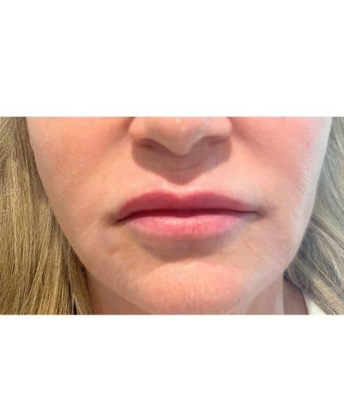After Image: Before and After fully healed lips - front