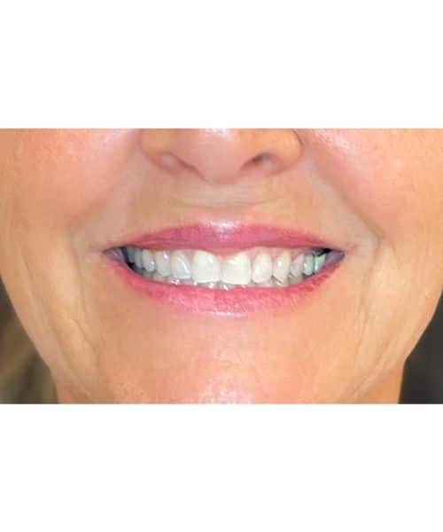 After Image: Before and After Full Lip Color - front