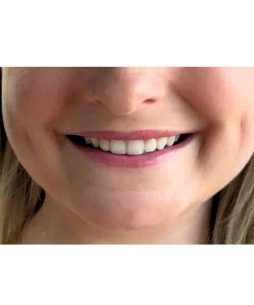 After Image: Lips - front