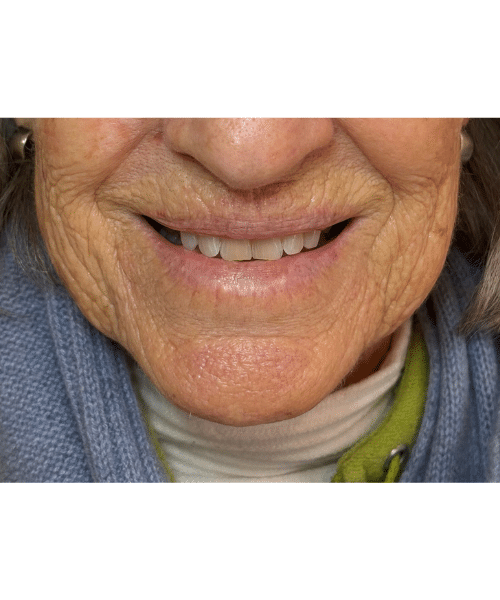 Before Image: Before & After Lip Blushing - front
