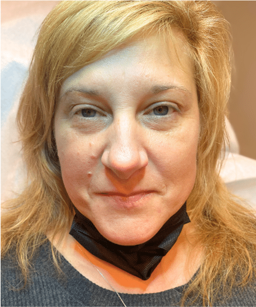 Before Image: Fully healed Eyebrows, Eyeliner & Lip Color - front