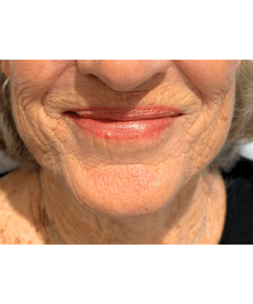 After Image: Before & After Lip Blushing - front